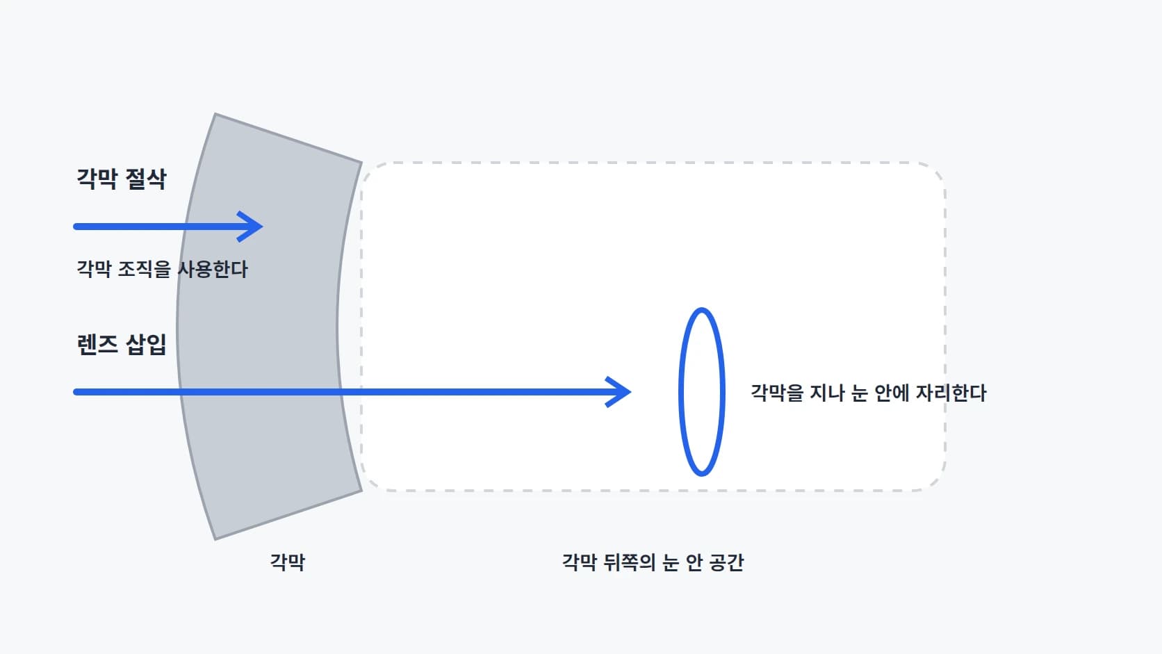 각막 층을 단순한 띠로 그리고 각막 조직을 사용하는 방식과 각막을 지나 눈 안에 자리하는 방식의 작용 지점을 표시한 도해