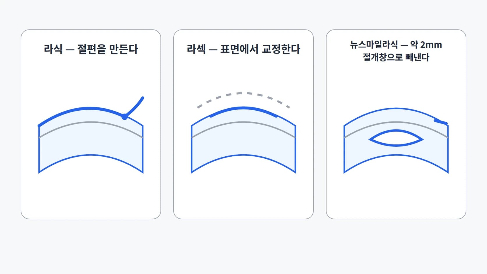 라식·라섹·뉴스마일라식이 각막의 어느 층에 어떻게 접근하는지 비교한 단면 모식도