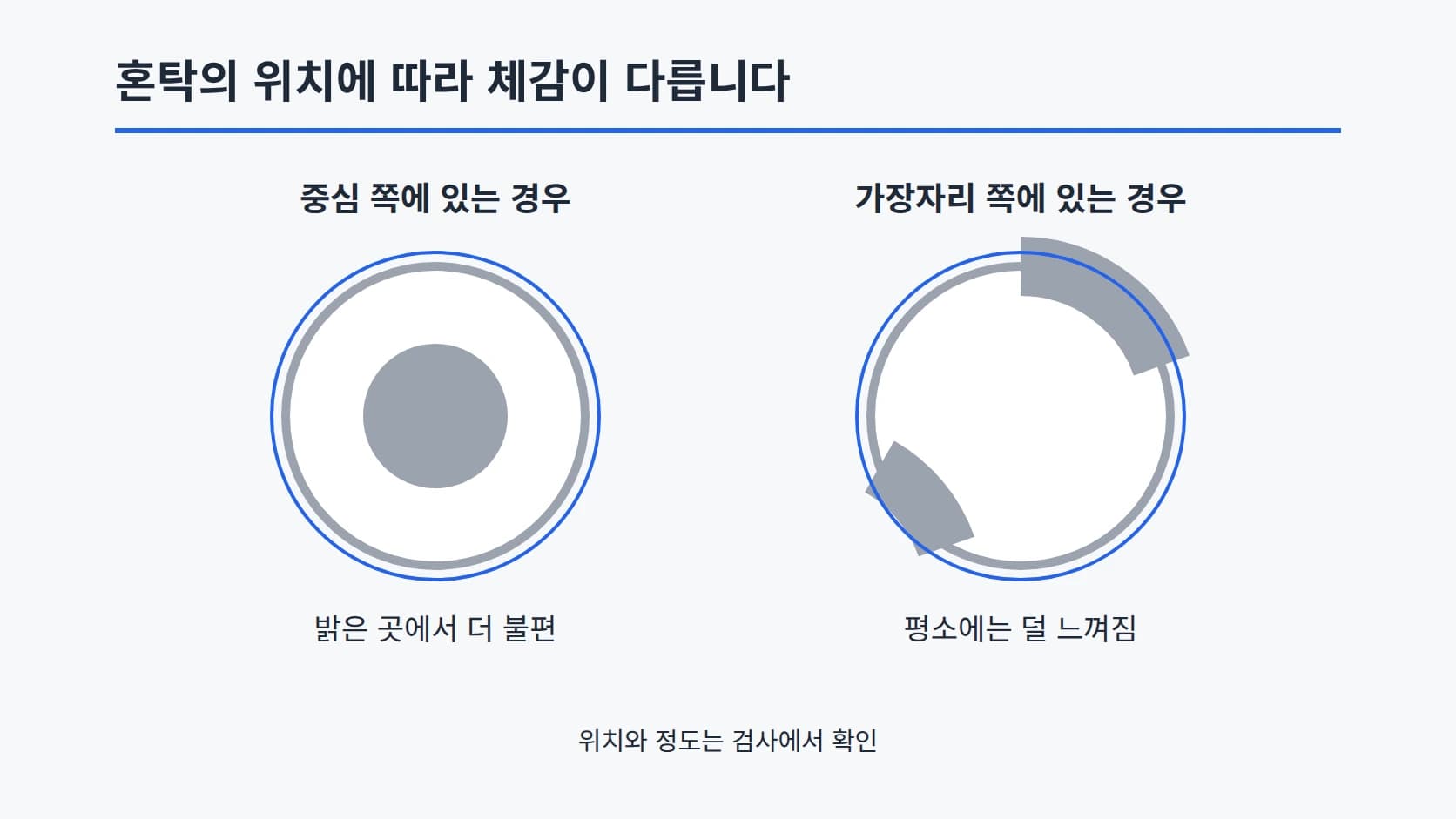 추상 원형 두 개로 혼탁이 중심 쪽에 있는 경우와 가장자리 쪽에 있는 경우를 회색 농담으로 비교한 2열 도식