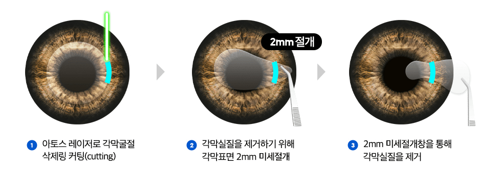 뉴스마일 라식 수술 과정 3단계 — ①아토스 레이저로 각막굴절 삭제링 커팅(cutting) ②각막실질을 제거하기 위해 각막표면 2mm 미세절개 ③2mm 미세절개창을 통해 각막실질을 제거