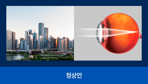 정상안 — 선명하게 보이는 시야