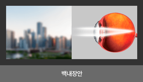 백내장안 — 뿌옇고 흐리게 보이는 시야