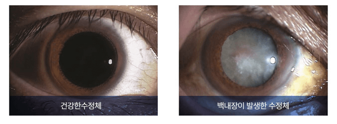 건강한 수정체와 백내장이 발생한 수정체 비교