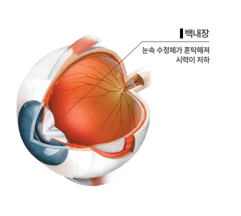 백내장 — 눈 속 수정체가 혼탁해져 시력이 저하되는 눈 단면 다이어그램