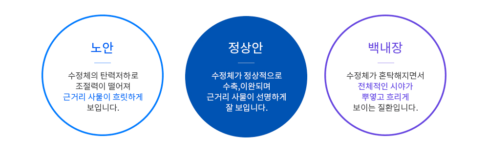 노안·정상안·백내장의 수정체 상태 비교 다이어그램