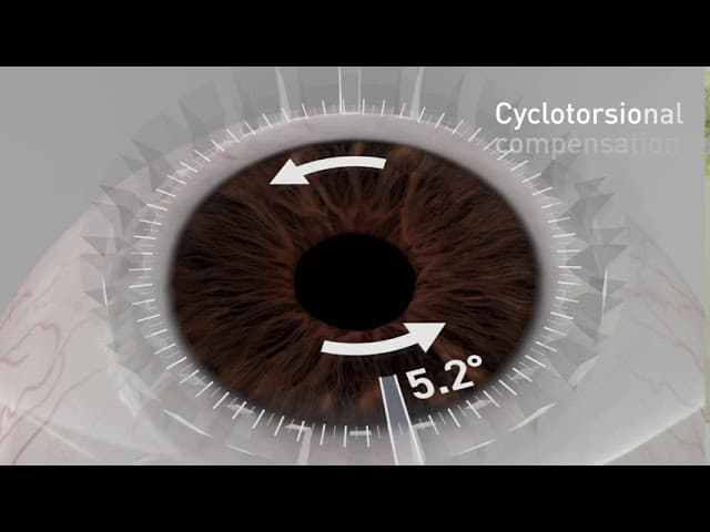 뉴스마일라식 Cyclotorsion 보정 영상 — 눈 회전 5.2도 추적 장면