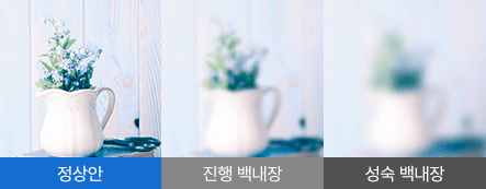 백내장 증상 예시 — 시력저하