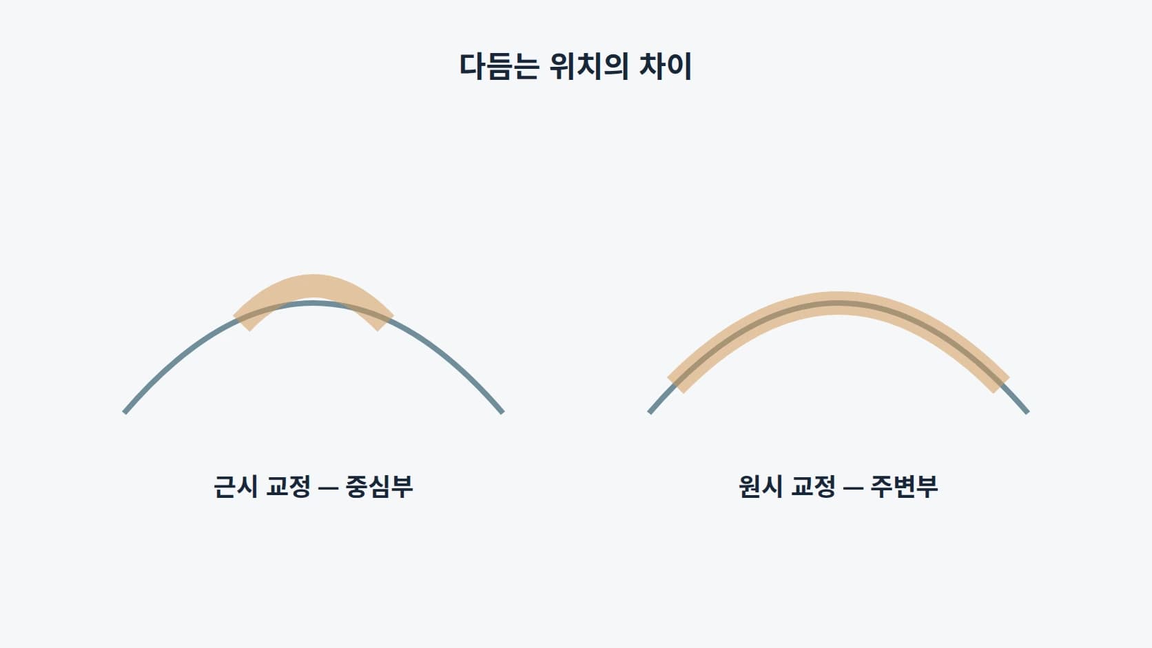 근시 교정은 중심부를, 원시 교정은 주변부를 다듬는다는 차이를 두 개의 단면 곡선으로 비교한 도해